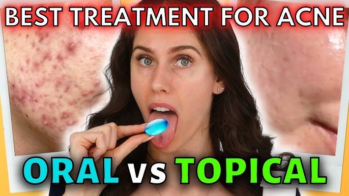 Oral vs Topical Medications